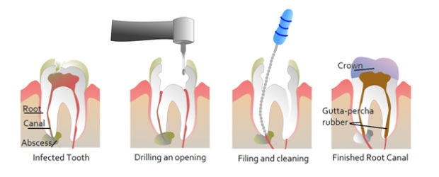 Tooth Root Canal Treatment in New Delhi